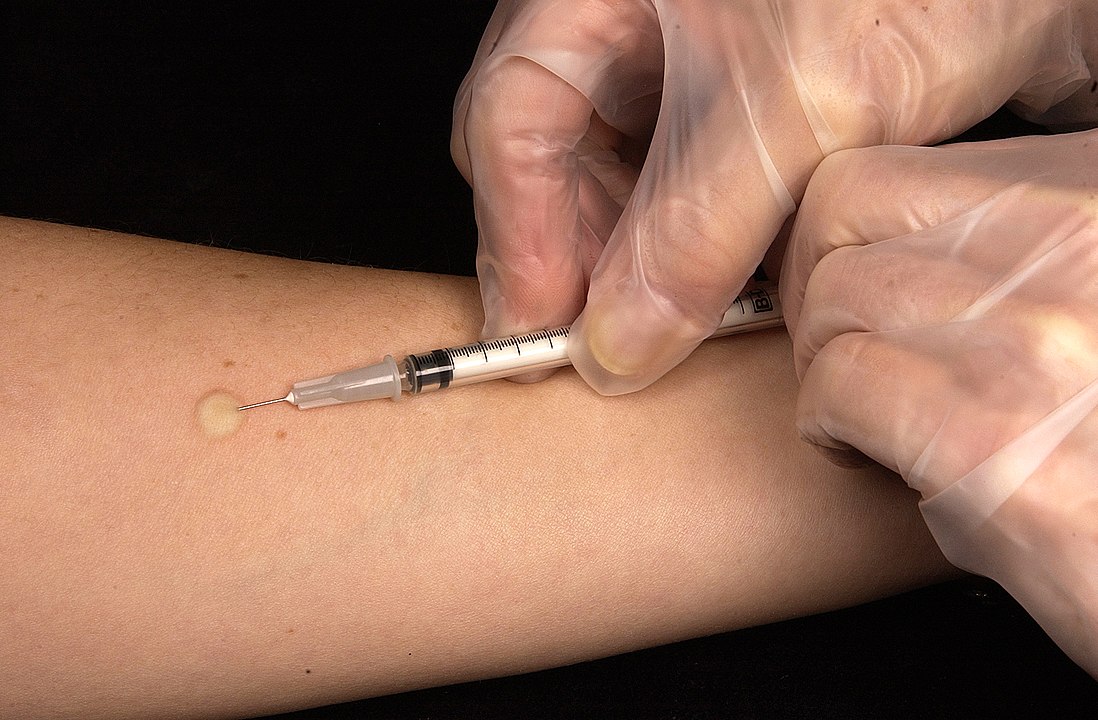 places to take the Mantoux test in Singapore